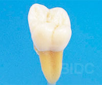 tooth extraction