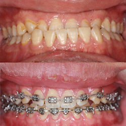 Fixed braces