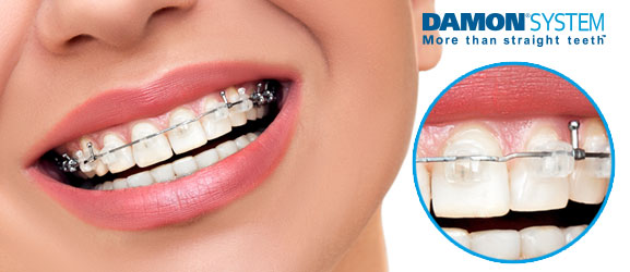 Damon braces