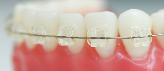 clear braces