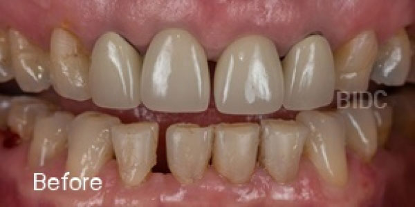 Full Mouth Rehabilitations