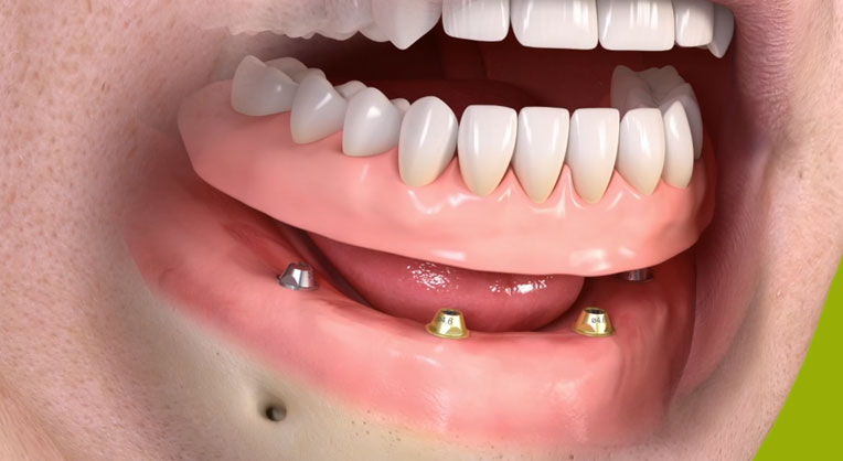 implant dentures