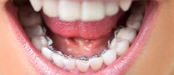 lingual braces