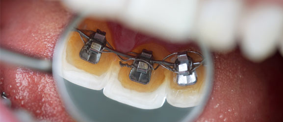 STb Lingual braces