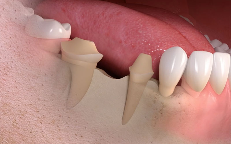 tooth bridge