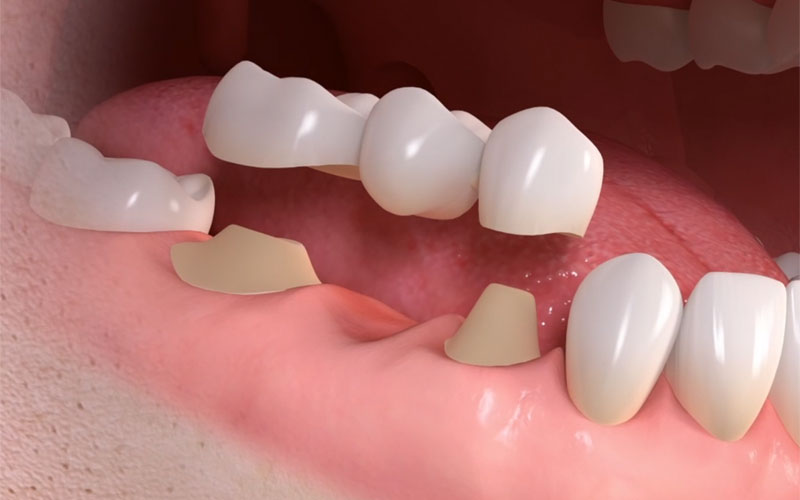 dental bridge