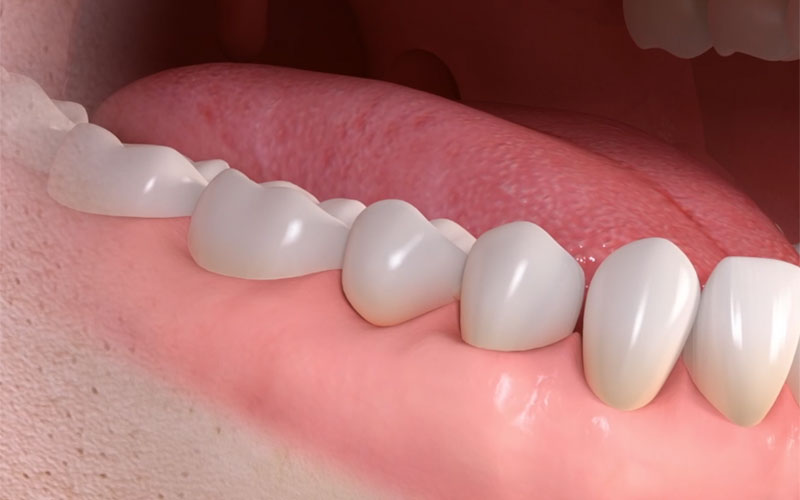 full teeth after dental bridge