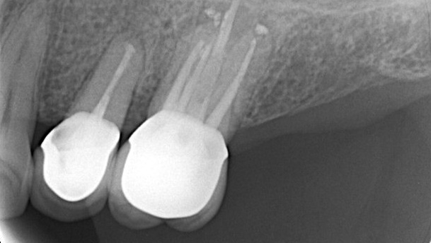 endodontics