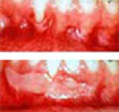 gum grafts