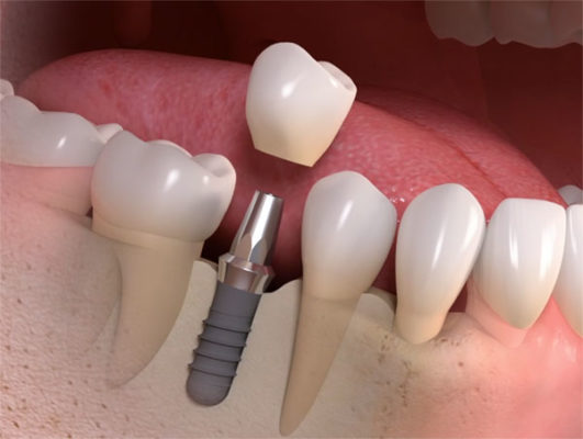 implant crown