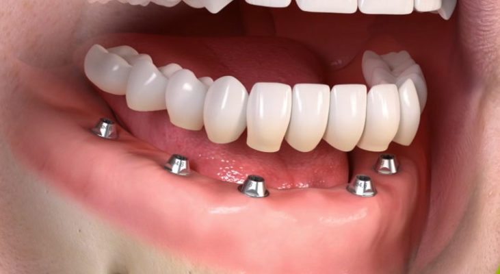 implant bridges