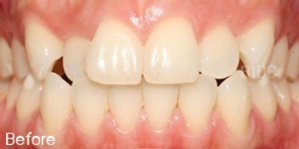 Invisalign and Braces