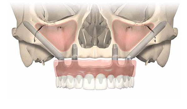 Zygoma Implants