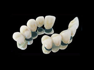 PFM dental bridge