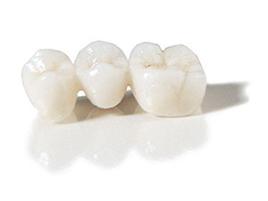 All Porcelain Bridge