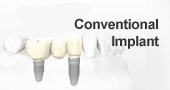 conventional dental implant