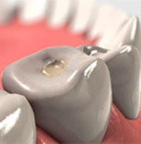 Dental Fillings