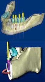 dental implant planning