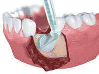 dental implant regenerative