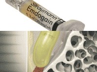 dental implant regenerative tissue