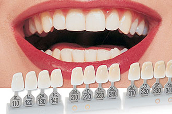 dental veneers fees