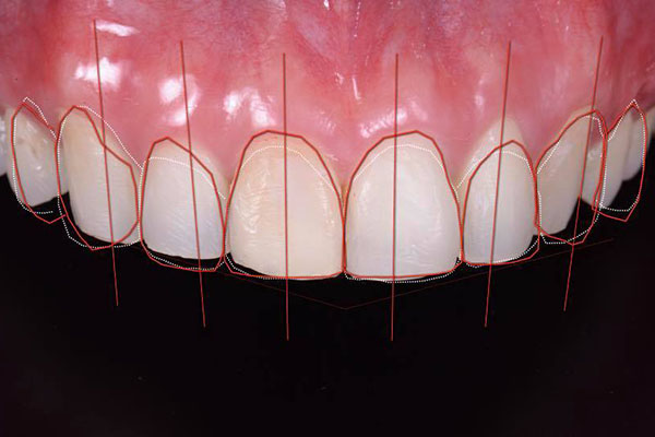 Digital Smile Design (DSD)