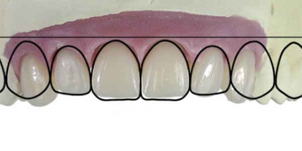 composite hybrid veneer
