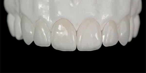 Direct Veneers