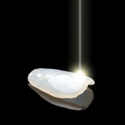 Direct Hybrid Veneers