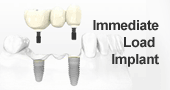 Immediate load implant