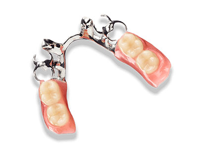 Metal-frame Dentures