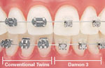 orthodontics self ligating braces