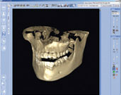 3D CT Scan romexis