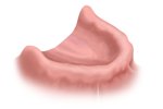 edentulous jaw