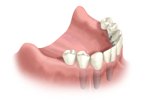 full implant bridges