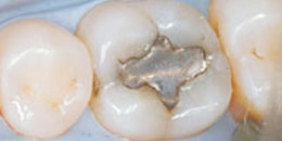 tooth fillings material