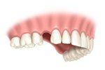 missing tooth
