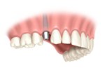 dental implant crown