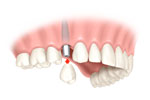 tooth implant crown