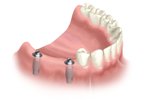 dental implant bridge