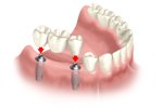 missing teeth implant bridge