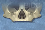 zygoma tooth implants