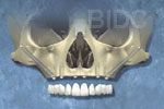 zygoma implant