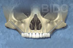 zygomatic implants