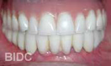 zygoma teeth