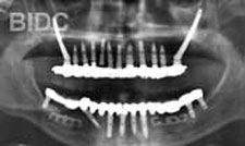 thailand zygoma implants