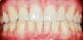 invisalign express case