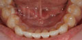 invisalign express case