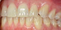 invisalign express case