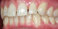 invisalign express case
